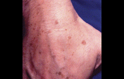 Age spots on hands