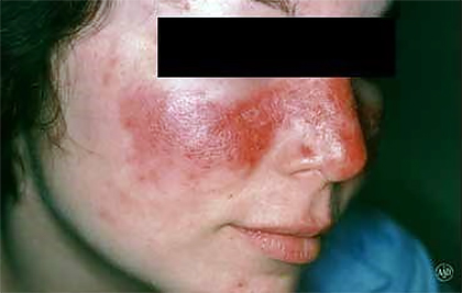 Butterfly rash of lupus