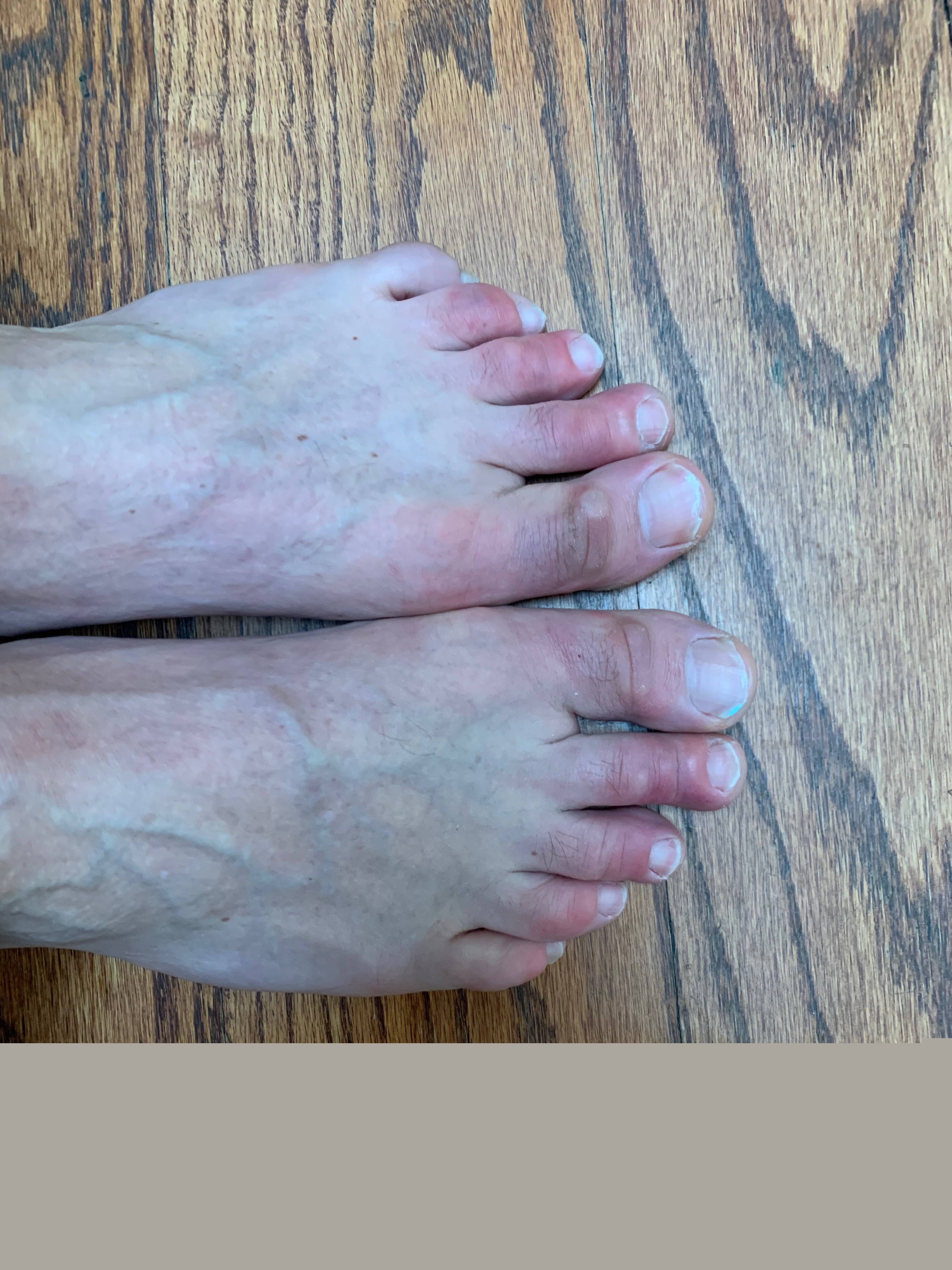 Image of COVID toes