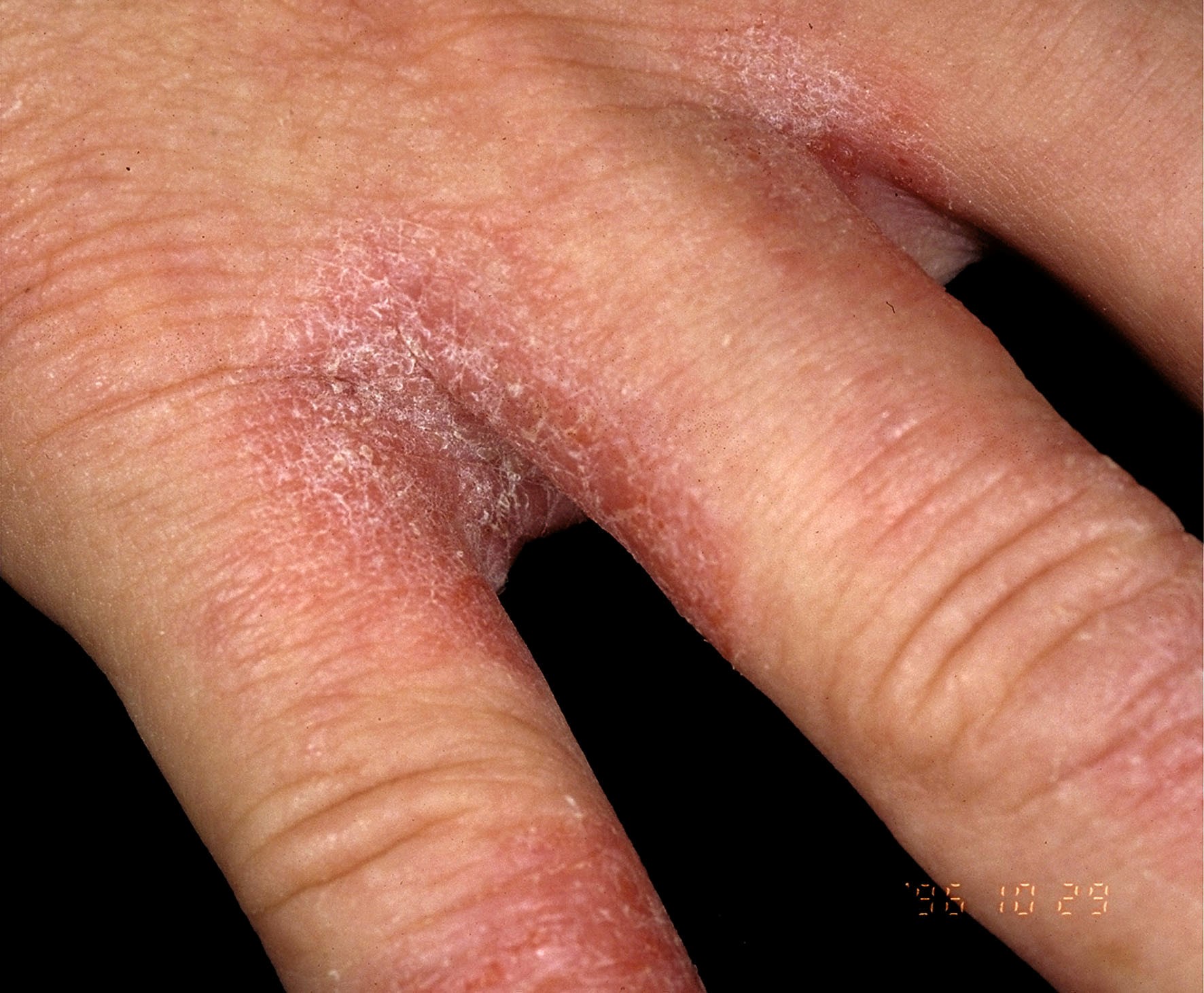 Illustration for DWII on PPE