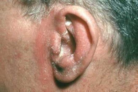 Seborrheic dermatitis on an ear of a man