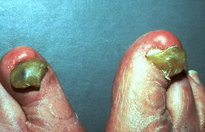 Thick, overgrown nails