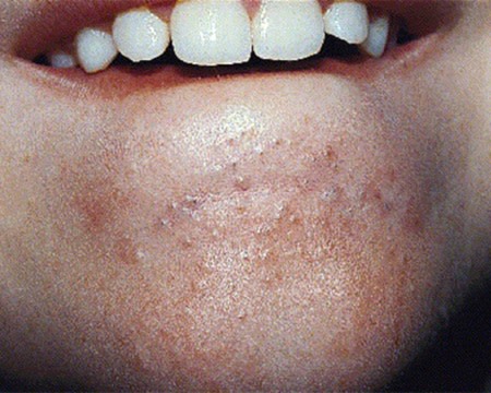 Blackheads and whiteheads