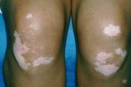 Vitiligo skin disease on the knees