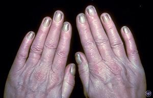 Yellow nail syndrome