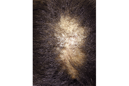 Black hair thinning at the crown