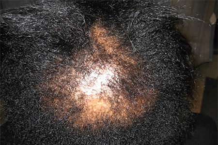 Scarring due to CCCA on woman’s scalp 