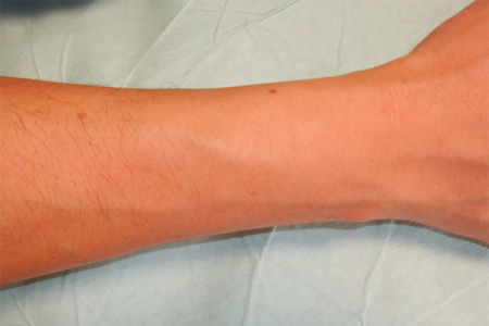 Complete loss of hair on lower part of arm 