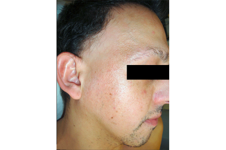 Small red bumps on face, receding hairline, patchy beard