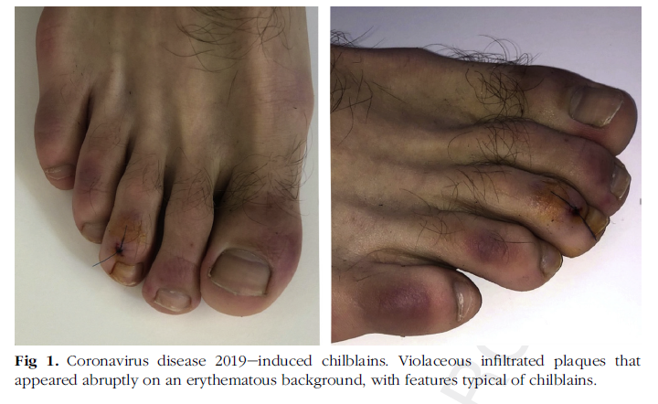 Kolivras A, et al. Coronavirus (COVID-19) infection-induced chilblains: A case report with histopathologic findings. JAAD Case Reports. 2020 (in press).
