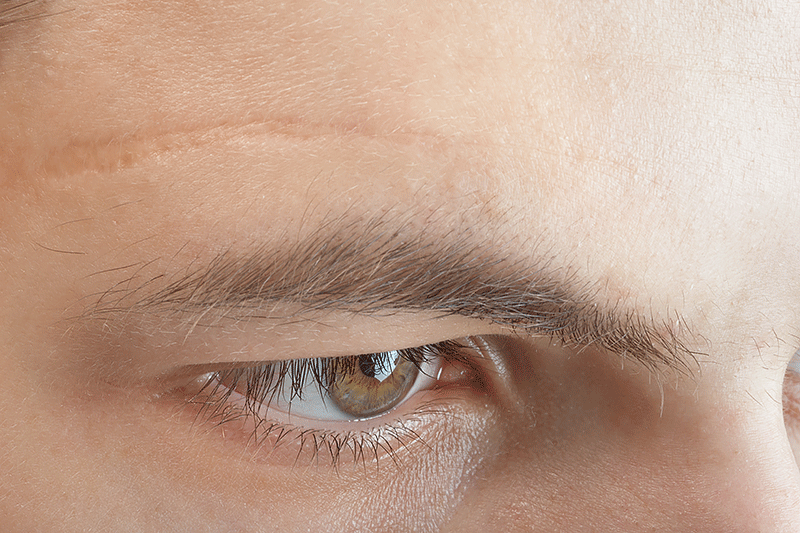 Scar on forehead
