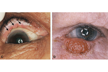 Side-by-side comparison images of two different patients with sebaceous carcinoma on their eyelids